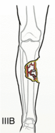 Grade IIIB open fracture clinical illustration